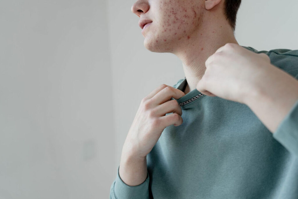 skin purging vs, breakouts