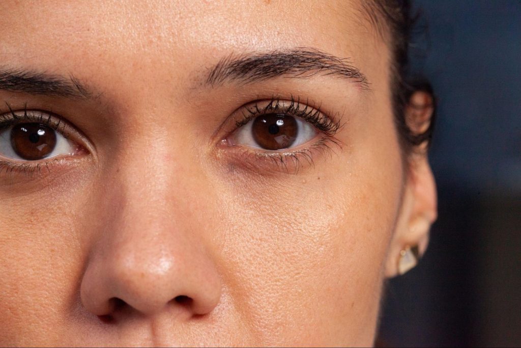 Practical Ways to Treat Dark Circles Under Your Eyes